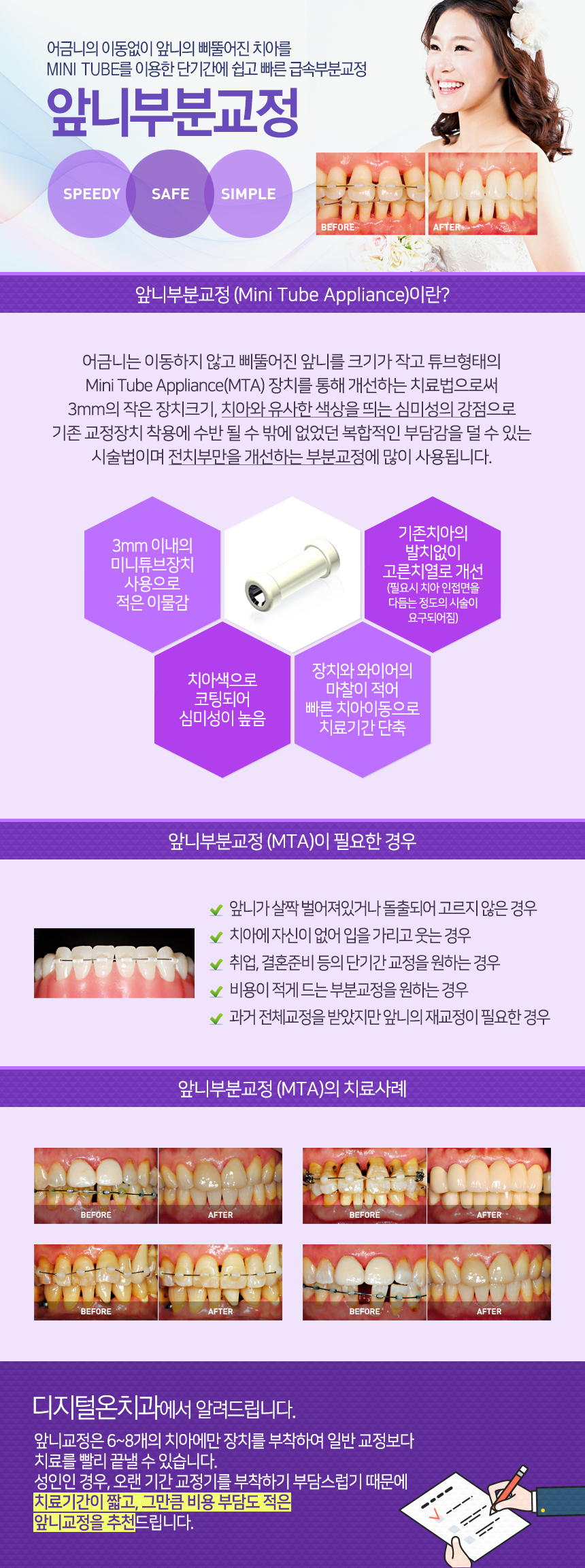 앞니부분교정