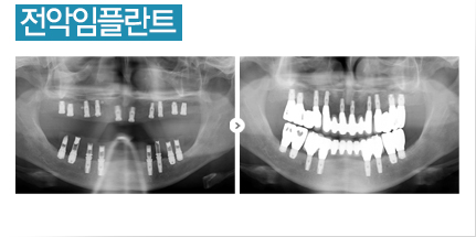 전악임플란트