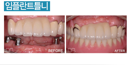 임플란트틀니