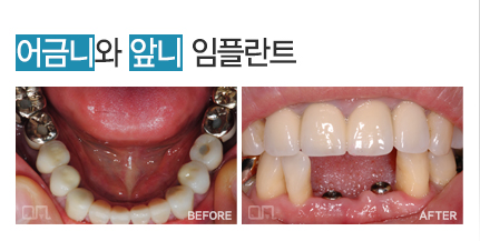 어금니와앞니임플란트