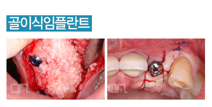 골이식임플란트